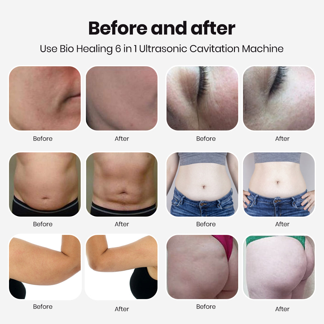 6-in-1 Cavitation & RF Beauty Machine For Saloon And Home